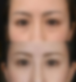 南昌大学医疗美容科涂飞翔内切眼袋真实案例
