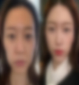 浙江省人民医院郭金才微整形注射案例,医生介绍和效果图