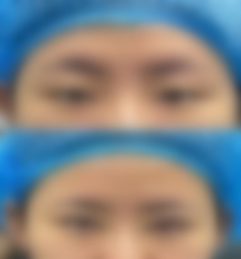 广东江门市人民医院谭文源双眼皮真实案例介绍