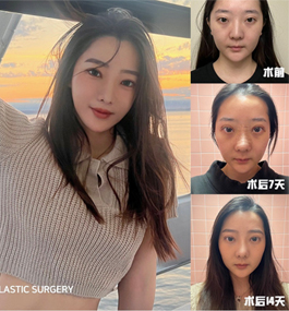 河南科技大学第一附属医院徐永飞全切双眼皮案例，附医生介绍和报价！