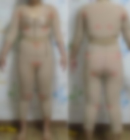 宿州市立医院韦元强吸脂案例解析