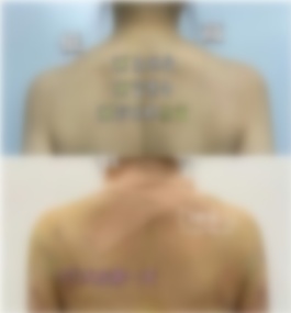 深圳富华医院吸脂真实案例与价格一览表？