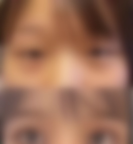 天津市第一中心医院刘光晶双眼皮真实案例以及介绍