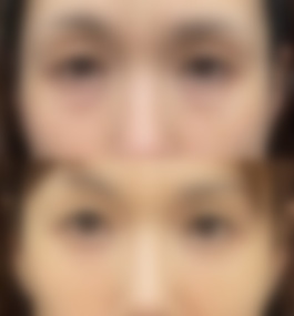 天津市第三中心医院刘海涛做双眼皮怎么样,医生真实案例分享