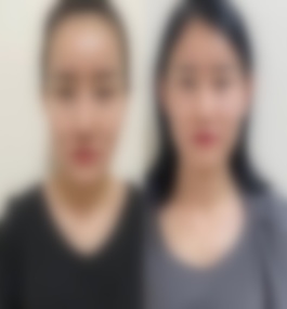 河南中医药大学第一附属医院葛艳娜面部年轻化真实案例及手术过程