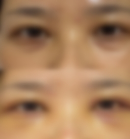 贵阳华美紫馨医院陈璐眶隔释放真实案例,介绍？