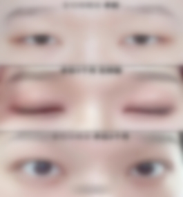 苏州美莱尹飞全切双眼皮案例与价格一览表？