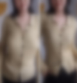 长沙人民医院罗滔医生巨乳缩小案例+医生介绍
