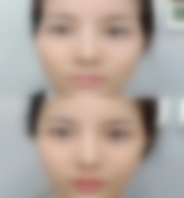 哈尔滨医科大学附属第一医院刁志勇填充案例分享以及医院介绍