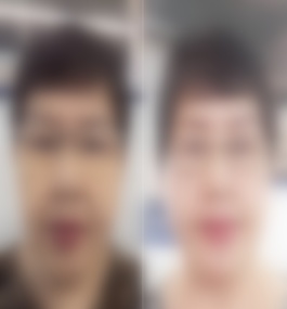 哈尔滨双燕医疗美容院腾双燕拉皮案例图展示