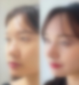赣南医学院第一附属医院谢林海医生隆鼻真实案例分享以及价格