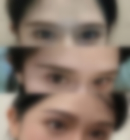 贵州利美康(总院)刘德东医生丰眉弓整形案例分享