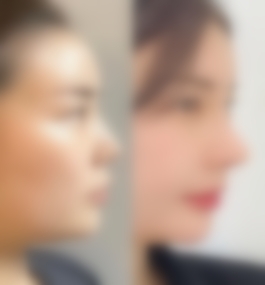 南昌韩美医院项昌峰隆鼻真实案例,价格表一览？