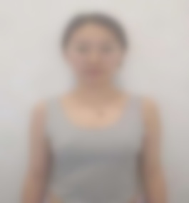 唐山金荣医疗美容院柴庆勋隆胸效果图及案例介绍