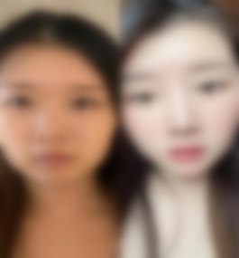 西安市第一医院吴琼隆鼻真实案例介绍