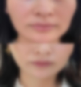 广州珠江医院齐向东磨骨案例介绍