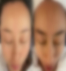 合肥恒美整形医院闫候旺皮肤抗衰案例分享