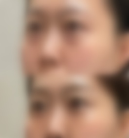 河北省眼科医院王健民祛眼袋案例介绍与分析