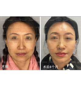 北京四季青橙杨俊中下面部拉皮4个月案例，拉皮案例多吗？