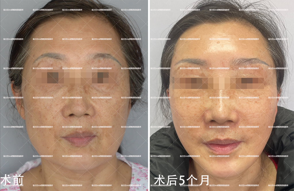 杨俊拉皮手术真实案例