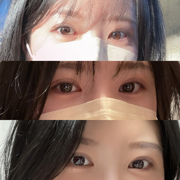 洛阳爱尚李冉双眼皮修复案例-523A-48D1-B286-7AA80C317471.jpeg