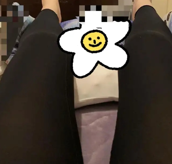 马冠楠大腿吸脂案例1.png