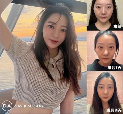 徐永飞双眼皮案例