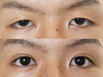 双眼皮案例.jpg